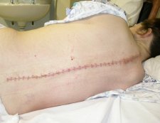 2 weeks after the operation.